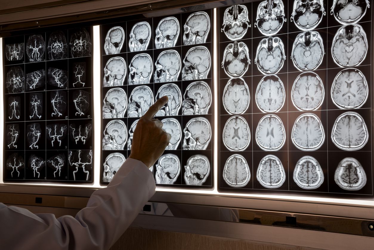 Alzheimer y otras demencias